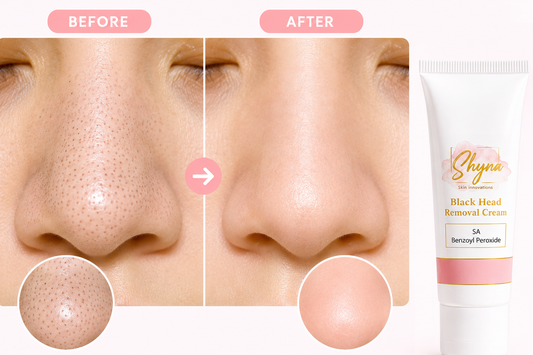 Blackhead Removal Cream: Triple Action Formula for Clear Skin