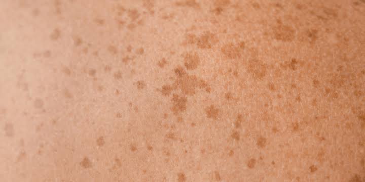 MELASMA AND PIGMENTATION