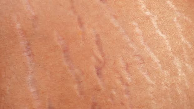 FAT REDUCTION AND STRECH MARKS